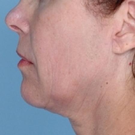 After image 2 Case #79331 - Non-Surgical Focused Ultrasound