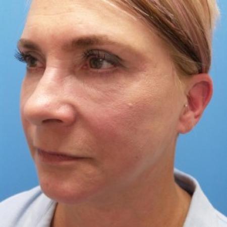 After image 2 Case #87176 - 57 year old  -  Facelift/Laser Resurfacing under eyes  -  1 year - 7 months post-op