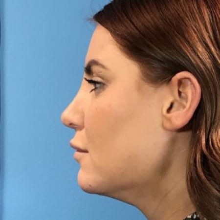 After image 3 Case #87356 - 27 year-old  -  Rhinoplasty/Septoplasty/Turbinectomy/Liposuction to Neck  -  2 months post-op