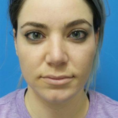 After image 3 Case #86936 - 29 year old  -  Rhinoplasty/Chin Augmentation/Submental Liposuction to Neck  -  2 months post-op