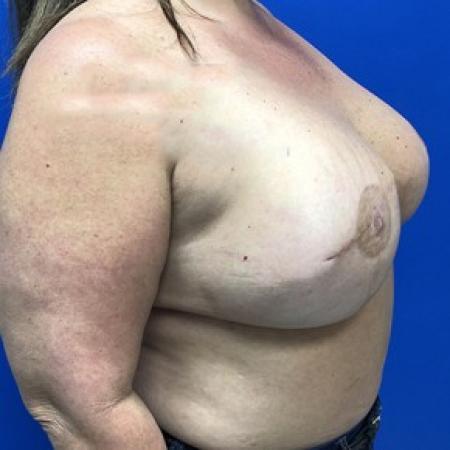 After image 2 Case #87331 - Right Tissue Expander to Implant Based Breast Reconstruction