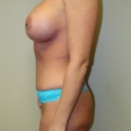 After image 4 Case #79036 - Tummy Tuck