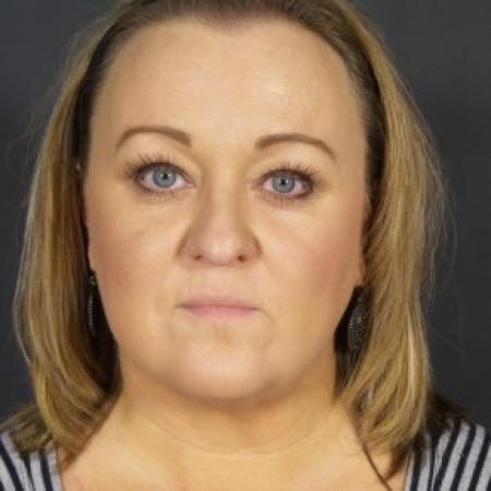 After image 1 Case #84736 - Liposuction Chin