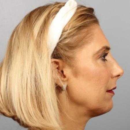 After image 2 Case #87416 - Full facial rejuvenation with Fat Injections