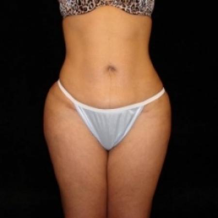 After image 1 Case #80456 - Buttocks Augmentation Via Fat Grafting with Liposuction of Abdomen, Waist, Flanks, Outer Thighs, and Mini Tummy Tuck