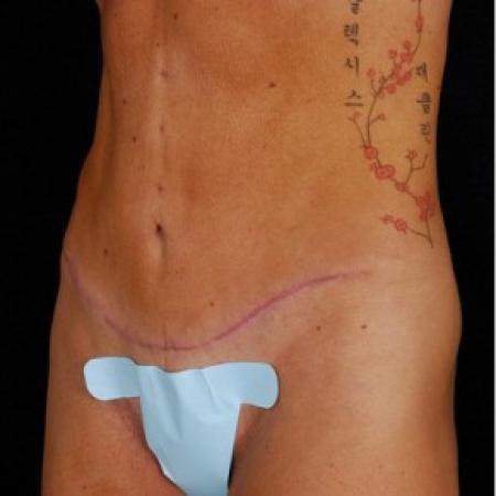 After image 2 Case #81571 - Tummy Tuck