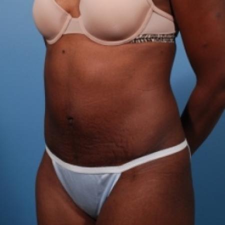 After image 2 Case #78871 - Abdominoplasty