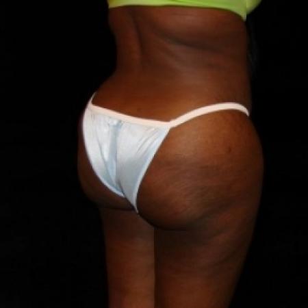 After image 4 Case #80486 - Buttocks Augmentation Via Fat Grafting with Liposuction of Abdomen, Waist, Flanks, and Dorsal Roll