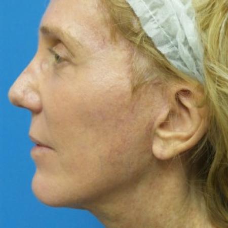 After image 3 Case #86746 - Facelift/Browlift/Laser Resurfacing to Full Face - 2 months post-op