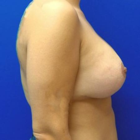 After image 3 Case #87236 - Breast Augmentation/Mastopexy
