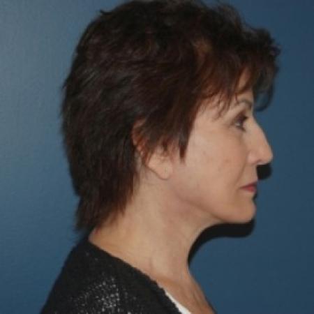 After image 2 Case #81101 - Facelift