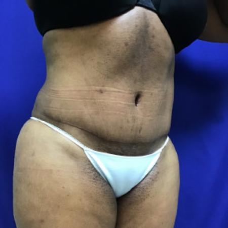 After image 2 Case #88281 - Tummy Tuck and Liposuction