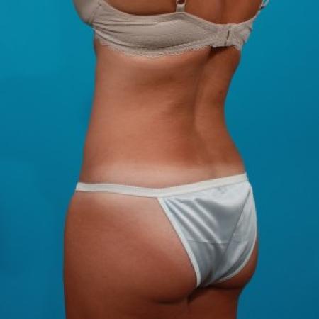 After image 4 Case #84106 - Abdominoplasty with Flank Lipo