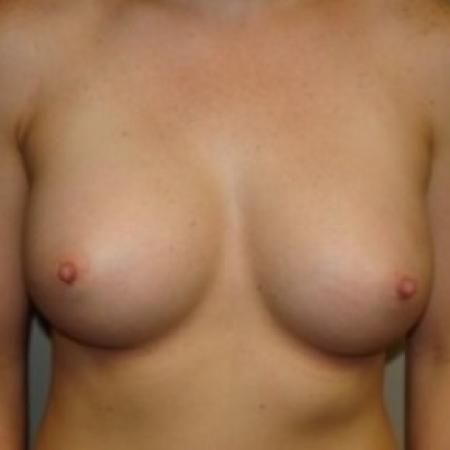 After image 1 Case #79386 - Breast Augmentation