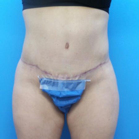 After image 1 Case #88171 - 41 year old  -  Abdominoplasty  -  3 months post-op