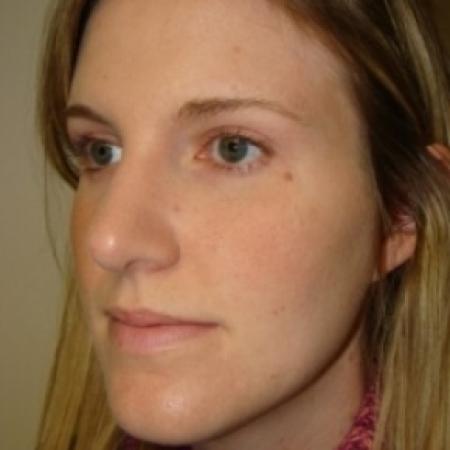 After image 2 Case #79551 - Rhinoplasty