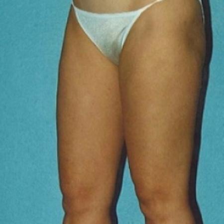 After image 3 Case #79171 - Liposuction