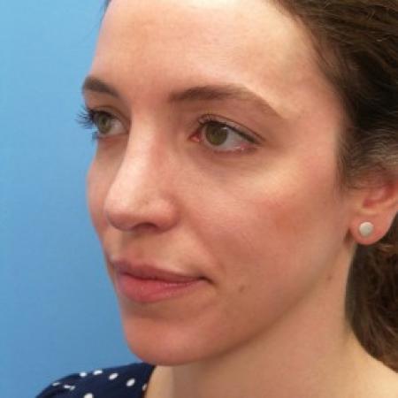 After image 2 Case #87411 - 31 year-old  -  Open Rhinoplasty/Endoscopic Browlift  -  3 months post-op