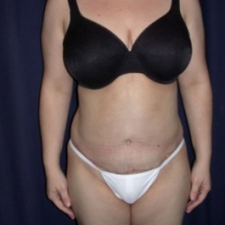 After image 1 Case #79816 - Tmmy Tuck/ Lipo-Abdominoplasty