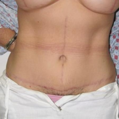After image 1 Case #85806 - Massive weight loss patient with Fleur-de-Lis abdominoplasty