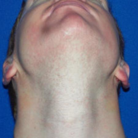 After image 3 Case #88341 - Otoplasty