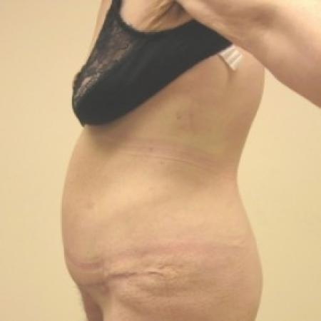 After image 3 Case #81141 - Abdominoplasty with ventral hernia repair