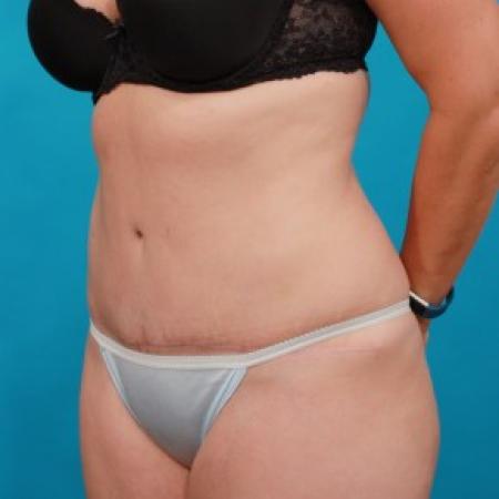 After image 2 Case #85721 - Abdominoplasty with Flank Liposuction