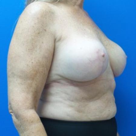 After image 2 Case #87281 - Breast Augmentation Revision