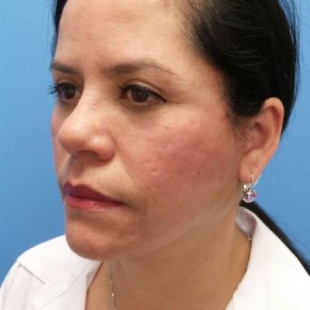 After image 2 Case #87341 - 54-year old - Upper & Lower Blepharoplasty/Facelift/Fat Grafting  to  Upper Cheeks & Lower Lids/Skin Resurfacing to both cheeks   3 months post-op