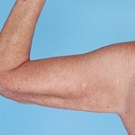 After image 2 Case #79226 - Liposuction