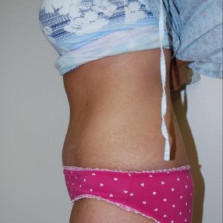 After image 3 Case #85811 - Traditional abdominoplasty after children