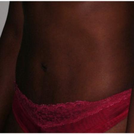 After image 2 Case #86971 - Tummy Tuck