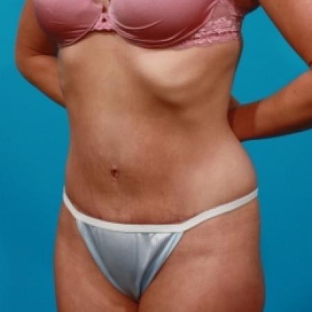 After image 2 Case #78946 - Tummy Tuck & Flank Lipo