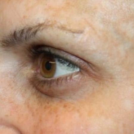 After image 2 Case #83891 - Botox (Crows Feet Only) - 34 year old female.