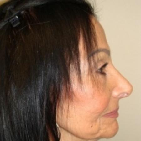 After image 3 Case #79546 - Rhinoplasty