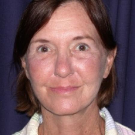 After image 1 Case #78811 - FaceLift- Minimal Access Cranial Suspension (MACS)/ Fat Grafting 