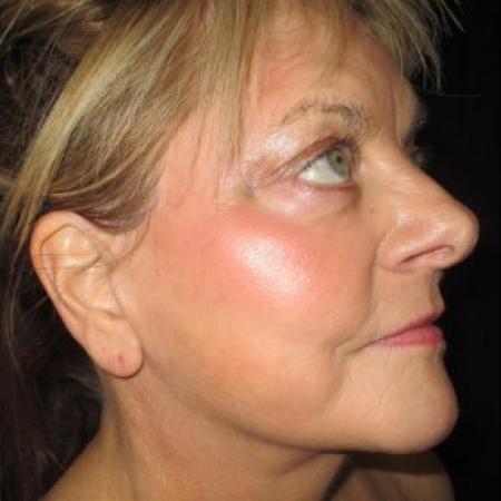 After image 2 Case #82711 - Fat Transfer to Face