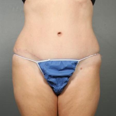 After image 1 Case #83611 - Liposuction Hips