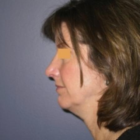 After image 3 Case #81151 - Rhinoplasty