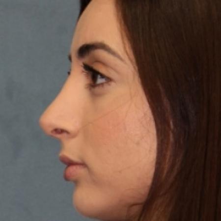 After image 3 Case #80826 - Rhinoplasty