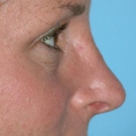 After image 2 Case #79261 - Rhinoplasty