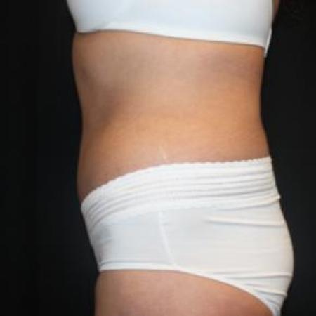 After image 3 Case #85866 - Total Body Lift - 57 year old female