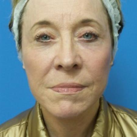After image 1 Case #87181 - 68 year old  -  Facelift  -  3 months post-op