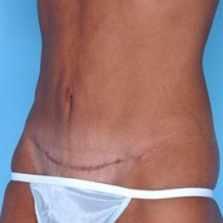 After image 3 Case #79166 - Tummy Tuck