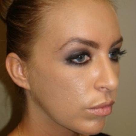 After image 4 Case #80476 - Open Rhinoplasty