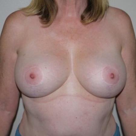 After image 1 Case #82811 - Vertical Mastopexy