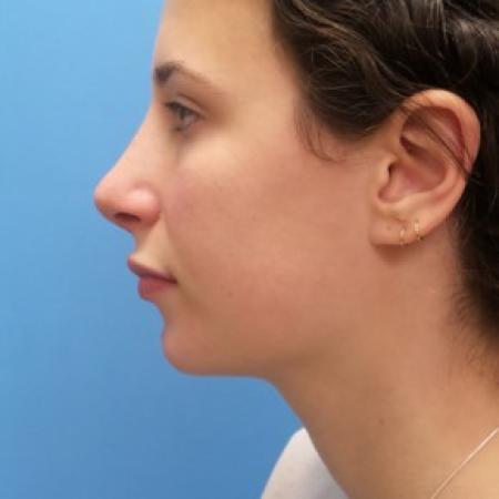 After image 3 Case #86456 - Rhinoplasty - 3 months post-op