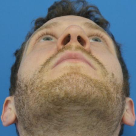 After image 4 Case #102251 - 31 year old  -  Open Rhinoplasty  -  3 months post-op
