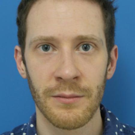 After image 3 Case #102251 - 31 year old  -  Open Rhinoplasty  -  3 months post-op