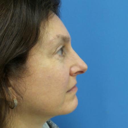 After image 3 Case #102181 - 58 year old  -  Browlift/Facelift/Lower Blepharoplasty/TCA Peel  -  10 months post-op
